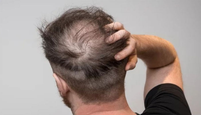 Gợi ý 10+ Cách trị rụng tóc tại nhà hiệu quả nhất chỉ sau 2 tuần Nguyên nhân gây rụng tóc