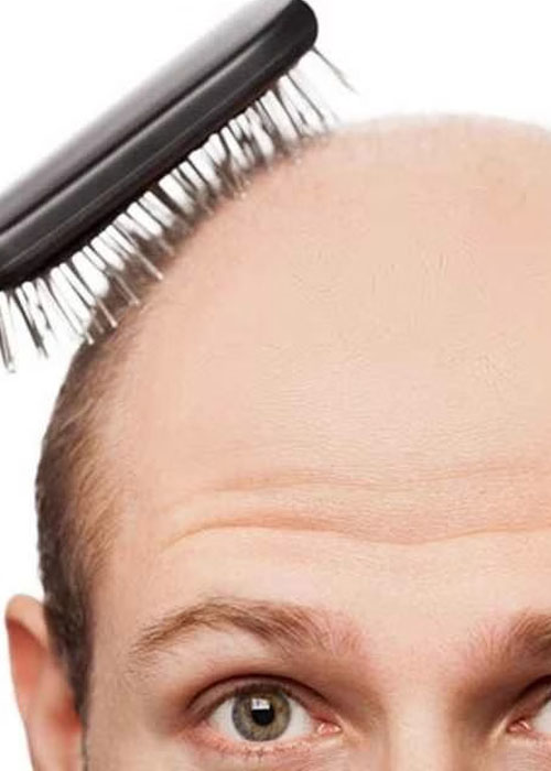 Hướng dẫn 5 Cách chữa rụng tóc bằng vỏ bưởi đơn giản tại nhà Tăng tiết DHT làm hói đầu