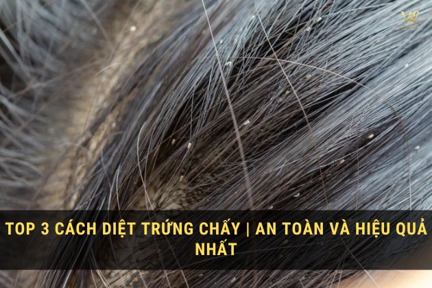 Cách diệt chấy và trứng