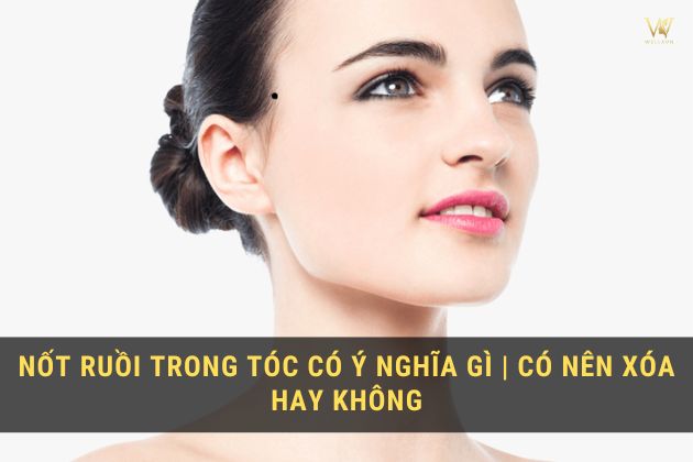 Nốt ruồi mọc trong tóc