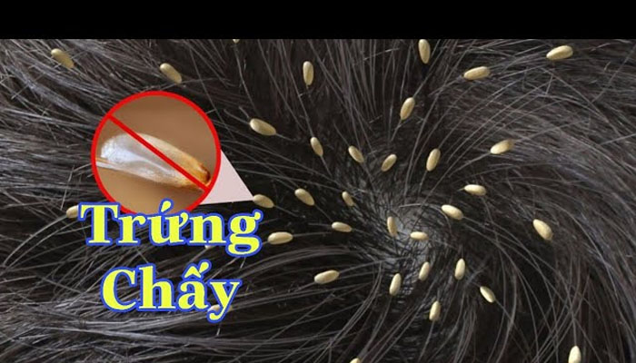 Top 3 cách diệt trứng chấy | An toàn và hiệu quả nhất trứng chấy trên da đầu
