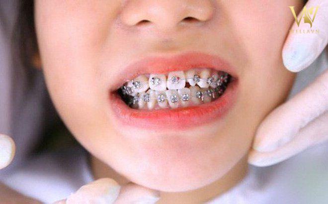 Có nên niềng răng cho trẻ 9 tuổi? | Vinmec