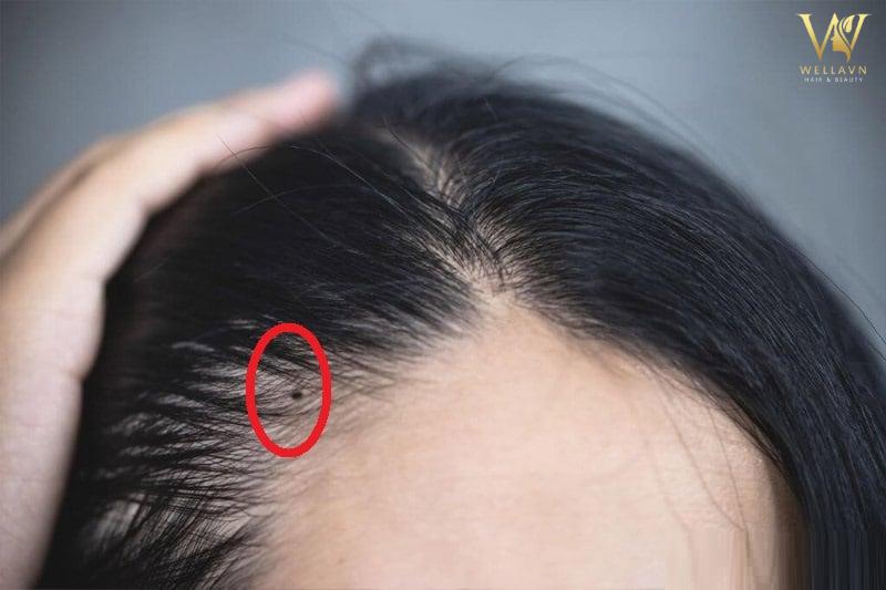 Nốt ruồi quý hơn vàng, ai có thì phúc lộc vô biên, tiền tài không cạn