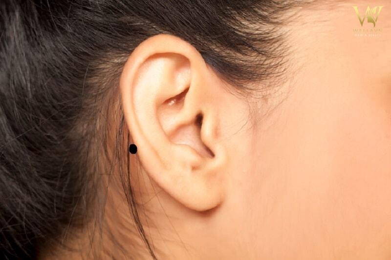 Vận mệnh người có nốt ruồi sau tai tốt hay xấu?