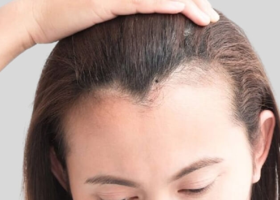 Nốt ruồi trên trán gần chân tóc có ý nghĩa gì? Có nên xóa hay không? nốt ruồi trên trán gần chân tóc